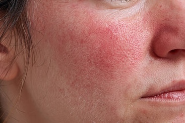 Close-up of cheek showing persistent facial redness