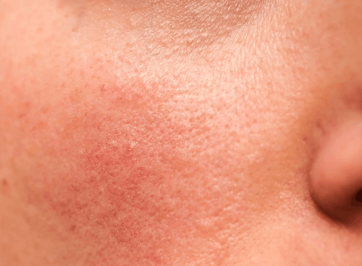 Close-up of cheek showing redness after breakouts have cleared